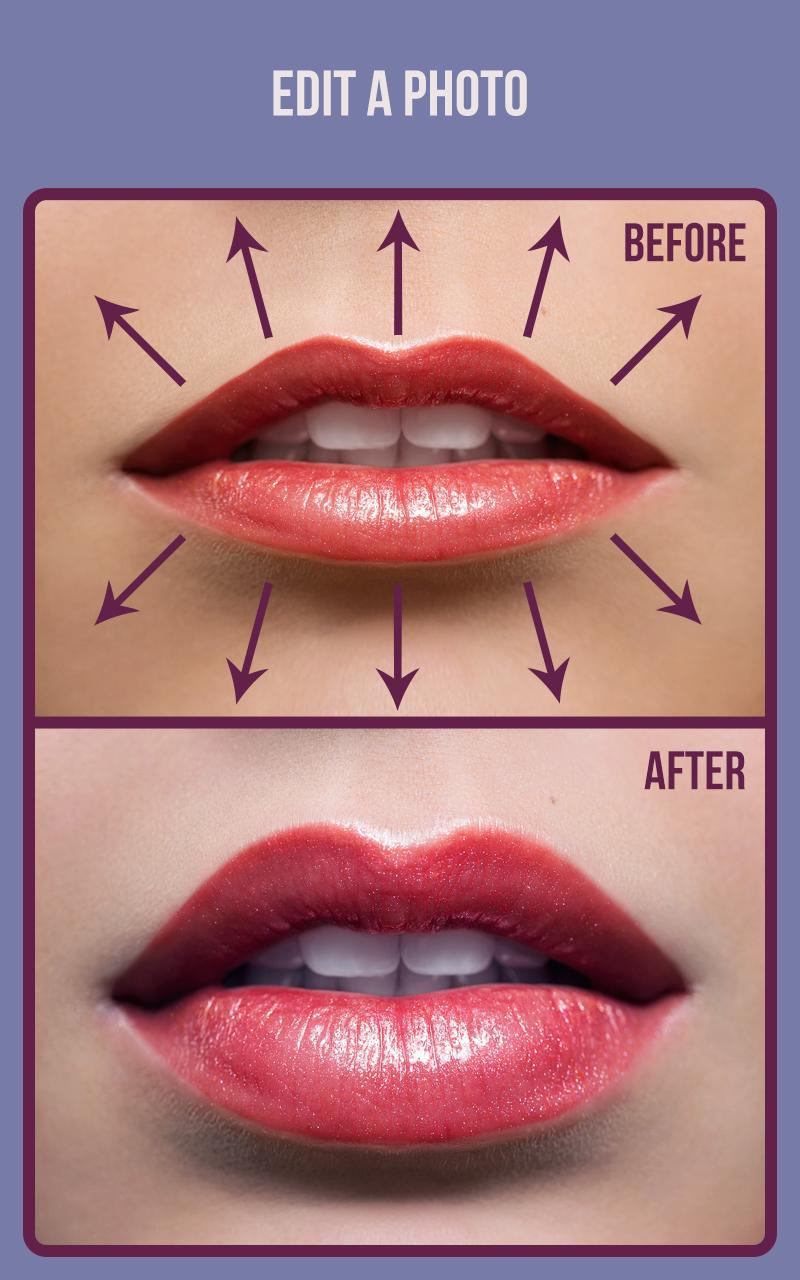 Rhinoplasty