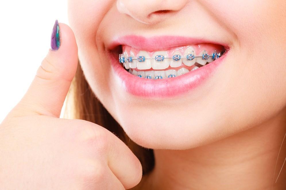 Real Braces Teeth